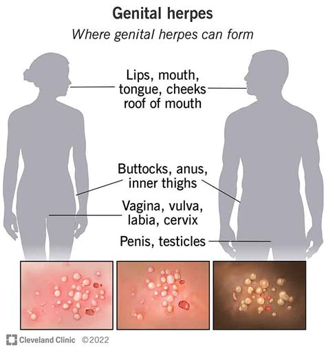 clitoral herpes|genital herpes outbreak symptoms female.